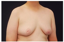 Male Breast Reduction Before Photo by Michael Law, MD; Raleigh, NC - Case 33587