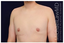 Male Breast Reduction After Photo by Michael Law, MD; Raleigh, NC - Case 33588