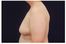 Male Breast Reduction Before Photo by Michael Law, MD; Raleigh, NC - Case 33588