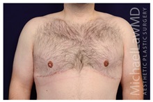 Male Breast Reduction After Photo by Michael Law, MD; Raleigh, NC - Case 33589