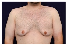 Male Breast Reduction Before Photo by Michael Law, MD; Raleigh, NC - Case 33589