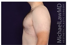 Male Breast Reduction After Photo by Michael Law, MD; Raleigh, NC - Case 33589