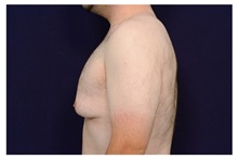 Male Breast Reduction Before Photo by Michael Law, MD; Raleigh, NC - Case 33589