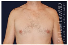 Male Breast Reduction After Photo by Michael Law, MD; Raleigh, NC - Case 33590