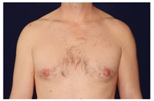 Male Breast Reduction Before Photo by Michael Law, MD; Raleigh, NC - Case 33590