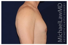 Male Breast Reduction After Photo by Michael Law, MD; Raleigh, NC - Case 33590