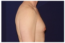 Male Breast Reduction Before Photo by Michael Law, MD; Raleigh, NC - Case 33590