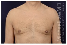 Male Breast Reduction After Photo by Michael Law, MD; Raleigh, NC - Case 33592