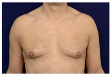 Male Breast Reduction Before Photo by Michael Law, MD; Raleigh, NC - Case 33592