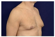 Male Breast Reduction Before Photo by Michael Law, MD; Raleigh, NC - Case 33592