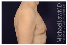 Male Breast Reduction After Photo by Michael Law, MD; Raleigh, NC - Case 33592