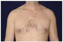 Male Breast Reduction Before Photo by Michael Law, MD; Raleigh, NC - Case 33593
