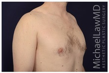 Male Breast Reduction After Photo by Michael Law, MD; Raleigh, NC - Case 33593