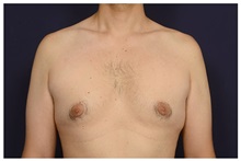 Male Breast Reduction Before Photo by Michael Law, MD; Raleigh, NC - Case 33594