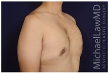 Male Breast Reduction After Photo by Michael Law, MD; Raleigh, NC - Case 33594