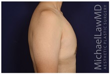 Male Breast Reduction After Photo by Michael Law, MD; Raleigh, NC - Case 33594
