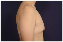 Male Breast Reduction Before Photo by Michael Law, MD; Raleigh, NC - Case 33594