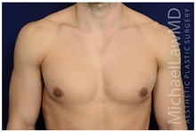 Male Breast Reduction After Photo by Michael Law, MD; Raleigh, NC - Case 33595