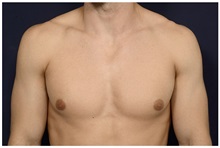 Male Breast Reduction Before Photo by Michael Law, MD; Raleigh, NC - Case 33595