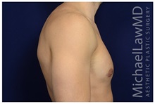 Male Breast Reduction After Photo by Michael Law, MD; Raleigh, NC - Case 33595