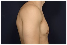 Male Breast Reduction Before Photo by Michael Law, MD; Raleigh, NC - Case 33595