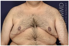 Male Breast Reduction After Photo by Michael Law, MD; Raleigh, NC - Case 33596