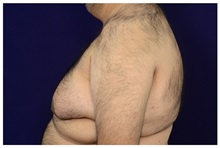 Male Breast Reduction Before Photo by Michael Law, MD; Raleigh, NC - Case 33596