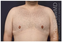 Male Breast Reduction After Photo by Michael Law, MD; Raleigh, NC - Case 33597