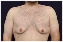 Male Breast Reduction Before Photo by Michael Law, MD; Raleigh, NC - Case 33597