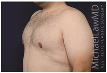 Male Breast Reduction After Photo by Michael Law, MD; Raleigh, NC - Case 33597