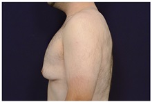 Male Breast Reduction Before Photo by Michael Law, MD; Raleigh, NC - Case 33597