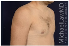Male Breast Reduction After Photo by Michael Law, MD; Raleigh, NC - Case 33598