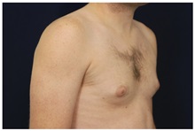 Male Breast Reduction Before Photo by Michael Law, MD; Raleigh, NC - Case 33598