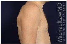 Male Breast Reduction After Photo by Michael Law, MD; Raleigh, NC - Case 33598