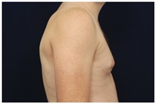 Male Breast Reduction Before Photo by Michael Law, MD; Raleigh, NC - Case 33598