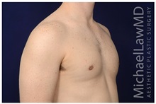 Male Breast Reduction After Photo by Michael Law, MD; Raleigh, NC - Case 33599