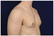 Male Breast Reduction Before Photo by Michael Law, MD; Raleigh, NC - Case 33599