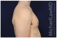 Male Breast Reduction After Photo by Michael Law, MD; Raleigh, NC - Case 33599