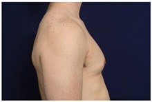 Male Breast Reduction Before Photo by Michael Law, MD; Raleigh, NC - Case 33599
