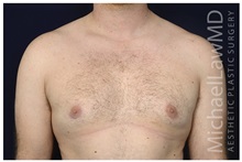 Male Breast Reduction After Photo by Michael Law, MD; Raleigh, NC - Case 33600