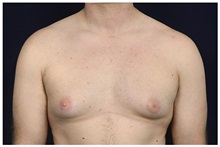Male Breast Reduction Before Photo by Michael Law, MD; Raleigh, NC - Case 33600