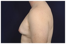 Male Breast Reduction Before Photo by Michael Law, MD; Raleigh, NC - Case 33600