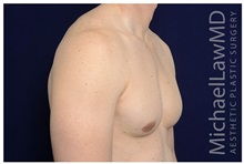 Male Breast Reduction After Photo by Michael Law, MD; Raleigh, NC - Case 33601