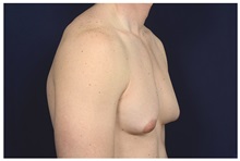 Male Breast Reduction Before Photo by Michael Law, MD; Raleigh, NC - Case 33601