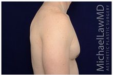 Male Breast Reduction After Photo by Michael Law, MD; Raleigh, NC - Case 33601
