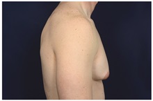 Male Breast Reduction Before Photo by Michael Law, MD; Raleigh, NC - Case 33601