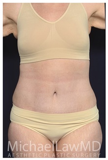 Tummy Tuck After Photo by Michael Law, MD; Raleigh, NC - Case 33602