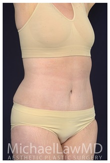 Tummy Tuck After Photo by Michael Law, MD; Raleigh, NC - Case 33602