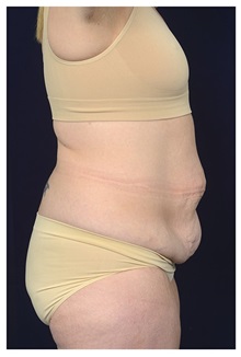 Tummy Tuck Before Photo by Michael Law, MD; Raleigh, NC - Case 33602