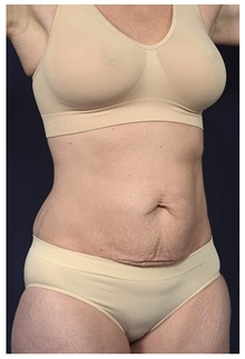 Tummy Tuck Before Photo by Michael Law, MD; Raleigh, NC - Case 33603